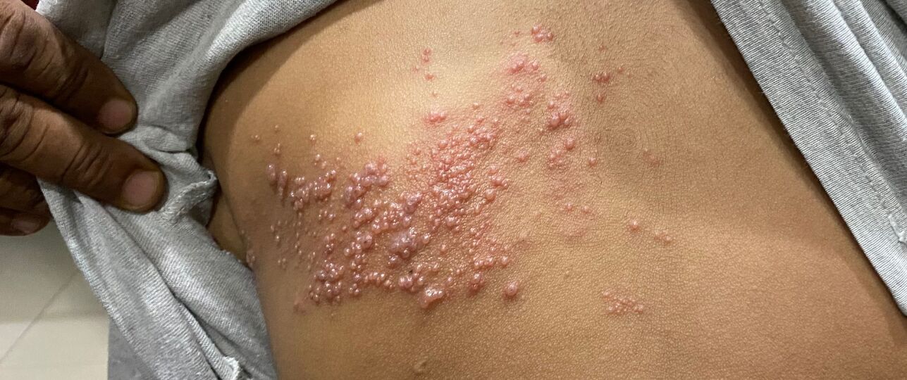 Helpt inenten tegen gordelroos? Zo zit het