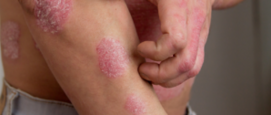 psoriasis